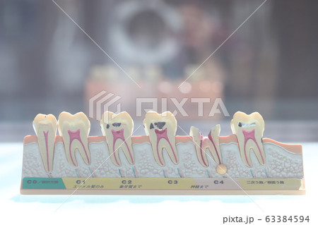 虫歯の説明模型 虫歯の説明模型 63384594