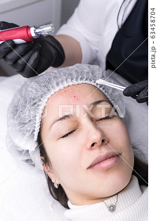 Micro needle mesotherapy. Derma pen Micro needle mesotherapy. Derma pen 63458704