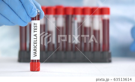 Hand wearing protection glove puts vial with varicella test on the table 63513614