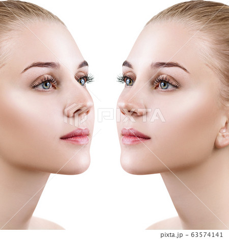 Female nose before and after cosmetic surgery. 63574141
