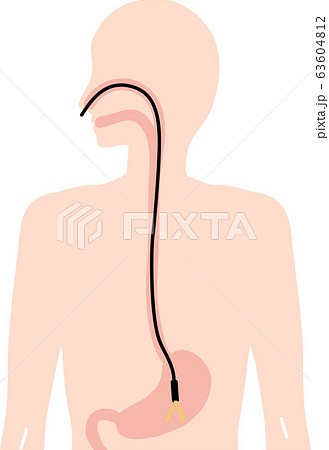胃カメラ 検査のイラスト素材