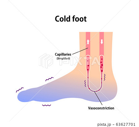 末端冷え性の足 イラスト (冷え性の原因) / 英語 末端冷え性の足 イラスト (冷え性の原因) / 英語 63627701