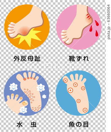 足のトラブル　４症例　イラスト 63660064