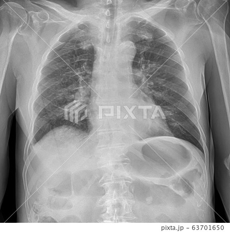 X-ray image of lung with pneumonia X-ray image of lung with pneumonia 63701650