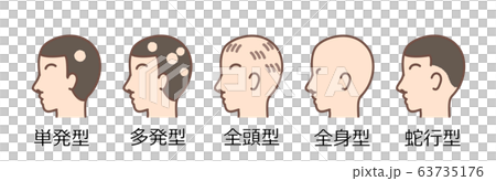 Alopecia Areata Classification With Characters... - Stock Illustration ...