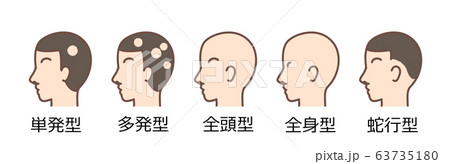 円形脱毛症 分類 横顔のイラスト素材