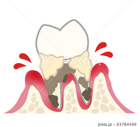 歯　重度歯周炎　出血　汚れあり 63764499