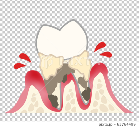 歯　重度歯周炎　出血　汚れあり 63764499