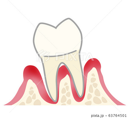 歯 重度歯周炎 歯 重度歯周炎 63764501