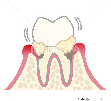 歯　中等度歯周炎　汚れあり 63764502