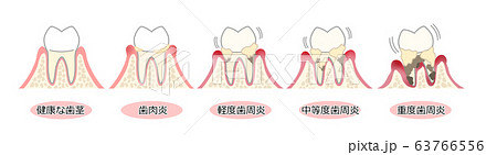 歯周病 図解 文字あり 歯周病 図解 文字あり 63766556