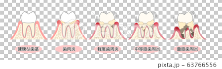 歯周病 図解 文字あり 歯周病 図解 文字あり 63766556