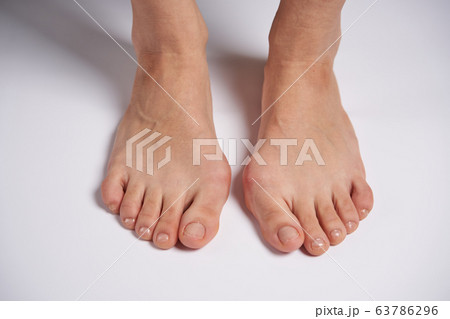 Hllux Valgus on female legs close up solated on Hllux Valgus on female legs close up solated on 63786296