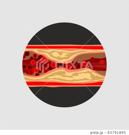 artery with blood cells desease 63791895