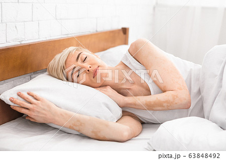Portrait of mature sleeping lady with vitiligo disease 63848492