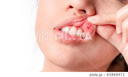 Asian women have aphthous ulcers on mouth on white Asian women have aphthous ulcers on mouth on white 63868471