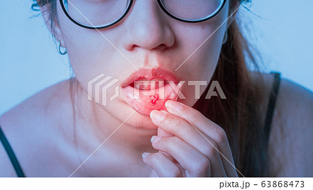 Asian women have aphthous ulcers on mouth, Asian women have aphthous ulcers on mouth, 63868473