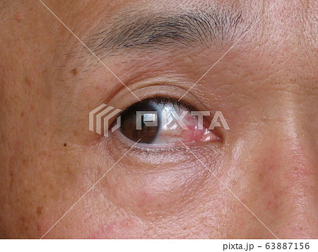 結膜膿疱　術後 63887156