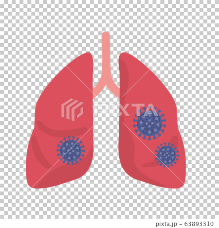 ウイルス感染をしている肺 イラスト ウイルス感染をしている肺 イラスト 63893310