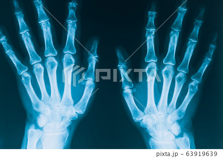 X-ray of hands. Real x-ray picture of hands, two hands in projection. Human bones. Medical concept. X-ray of hands. Real x-ray picture of hands, two hands in projection. Human bones. Medical concept. 63919639