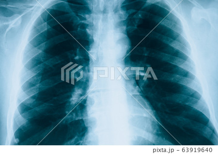 X-rays of lungs. Fluorography. Checking lungs in hospital. Real x-ray human lungs snapshot X-rays of lungs. Fluorography. Checking lungs in hospital. Real x-ray human lungs snapshot 63919640