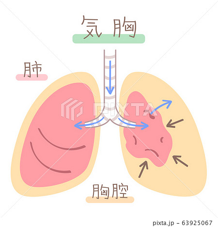 肺の図表 気胸 のイラスト素材