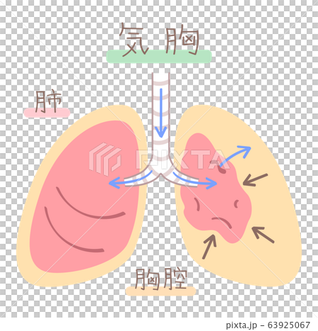 肺の図表 気胸 のイラスト素材