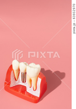 Example of Implants and dental tools. Example of Implants and dental tools. 63932970