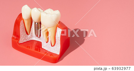 Example of Implants and dental tools. Example of Implants and dental tools. 63932977
