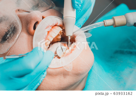 Dentist ultrasound removes stones on the teeth of Dentist ultrasound removes stones on the teeth of 63933162