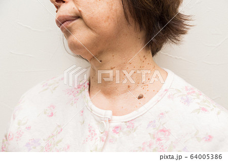 老人性イボ　首イボ 64005386