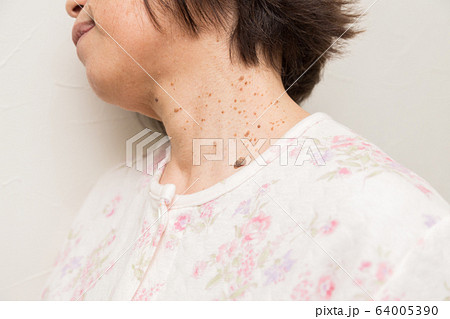 老人性イボ　首イボ 64005390