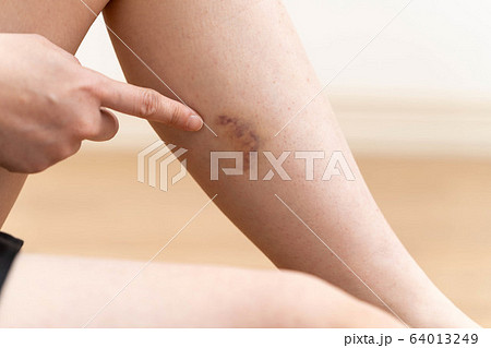 女性　あざ　脚 64013249