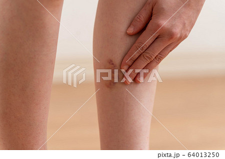 女性　あざ　脚 64013250