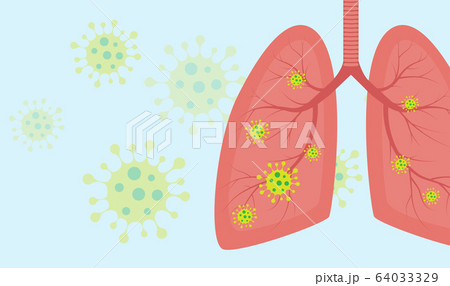 Virus cells in lung. Infected lungs. Coronavirus, COVID-19. 2019-nCoV. lung disease, pneumonia, asthma, cancer, tuberculosis. 64033329