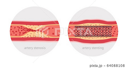 Stenting sick human artery, before and after, flat design illustration Stenting sick human artery, before and after, flat design illustration 64088108