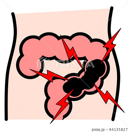 便秘 便秘 64135827