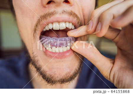 Man placing a bite plate in his mouth to protect his teeth at night from grinding caused by bruxism 64155868