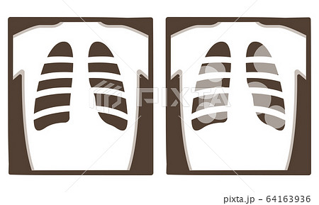 レントゲン 肺炎のイラスト素材
