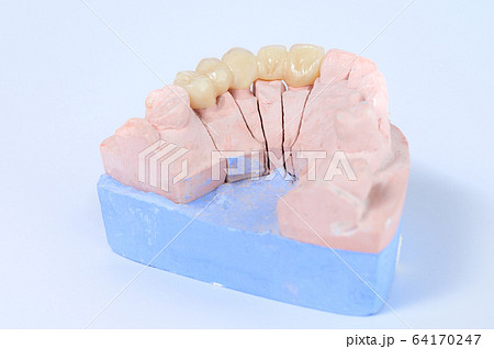 Ceramic tooth crown on plaster model Ceramic tooth crown on plaster model 64170247