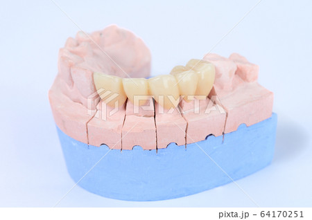 Ceramic tooth crown on plaster model Ceramic tooth crown on plaster model 64170251