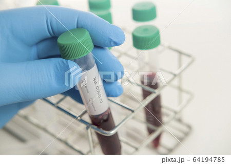 Close-up of hand in surgical glove holding blood sample 64194785