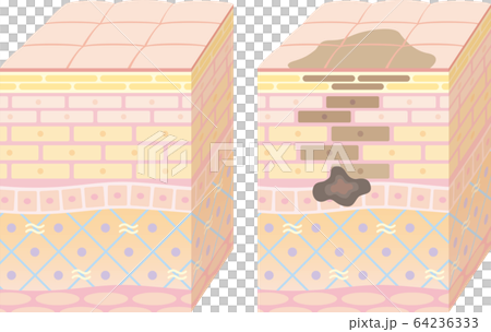 皮膚的3D剖面圖。健康和沾染皮膚。 皮膚的3D剖面圖。健康和沾染皮膚。 64236333