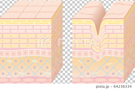 皮膚的3D剖面圖。健康的皮膚和皺紋的皮膚。 64236334