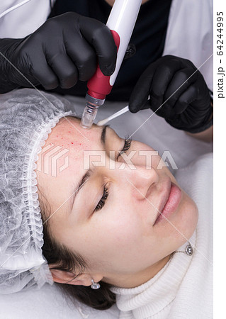 Micro needle mesotherapy. Derma pen 64244995
