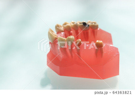 補綴説明模型 64363821