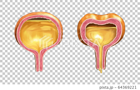 膀胱易怒性膀胱解剖 64369221