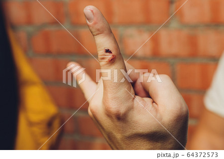 Bleeding blood from the cut finger wound. Injured finger with bleeding open cut wound. Closeup of finger human hand is cut hurt bleeding with bright red blood. 64372573