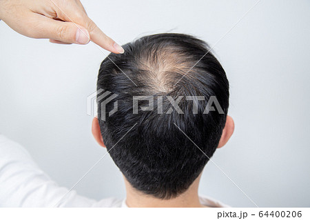 薄毛に悩む中年男性 薄毛に悩む中年男性 64400206