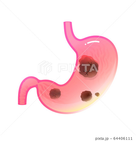 Vector isolated illustration of stomach cancer  64406111